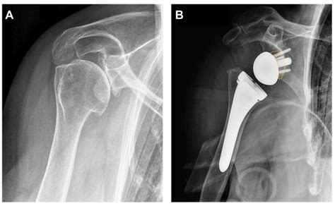 reverse total shoulder orthobullets|Reverse Total Shoulder Arthroplasty: Implant Design  .